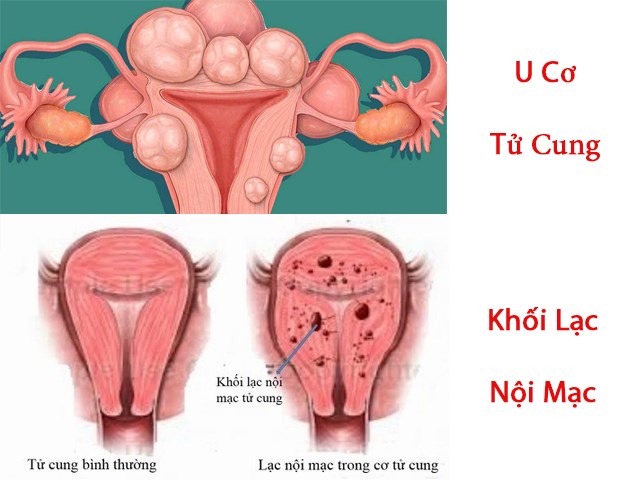 Một số nguyên nhân Bệnh Xuất Huyết Tử Cung Bất Thường
