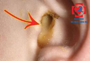 Dấu Hiệu Nhận Biết Bệnh Viêm Tai Giữa Cấp Tính