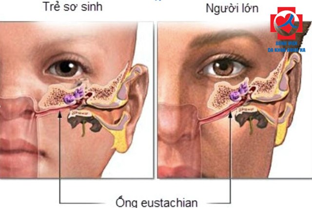 Cùng Tìm Hiểu Về bệnh Viêm Tai Giữa Cấp Tính