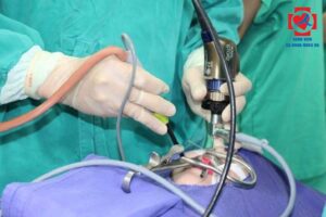 Phẫu thuật cắt AMIDAN Bằng Công Nghệ Dao PLASMA tại BV Hồng Hà