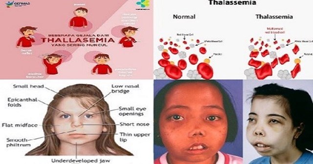 Hình ảnh minh hoạ Bệnh Tan Máu Bẩm Sinh (Thalassemia)