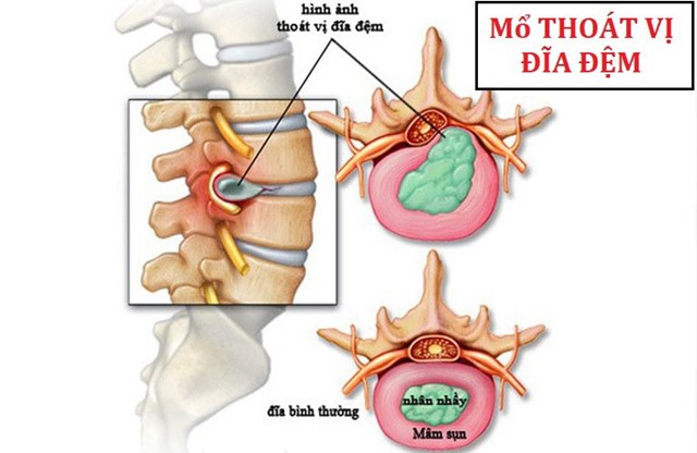 Những Dấu Hiệu, Triệu Chứng Của Thoát Vị Đĩa Đệm