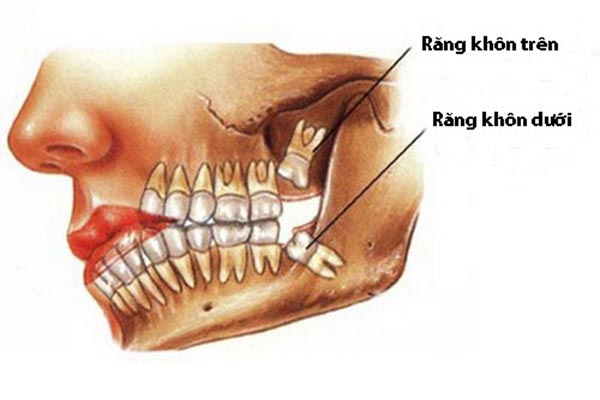 Ứng Dụng Chụp Cắt Lớp Vi Tính Răng Liều Xạ Thấp