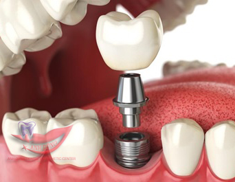 Chụp Cắt Lớp Vi Tính Răng được ứng dụng khá rộng rãi