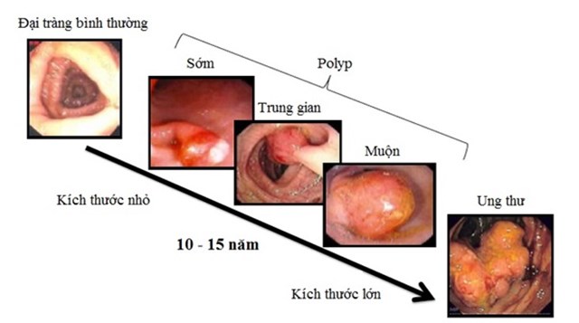 Quá trình tiến triển tự nhiên của polyp thành ung thư đại-trực tràng