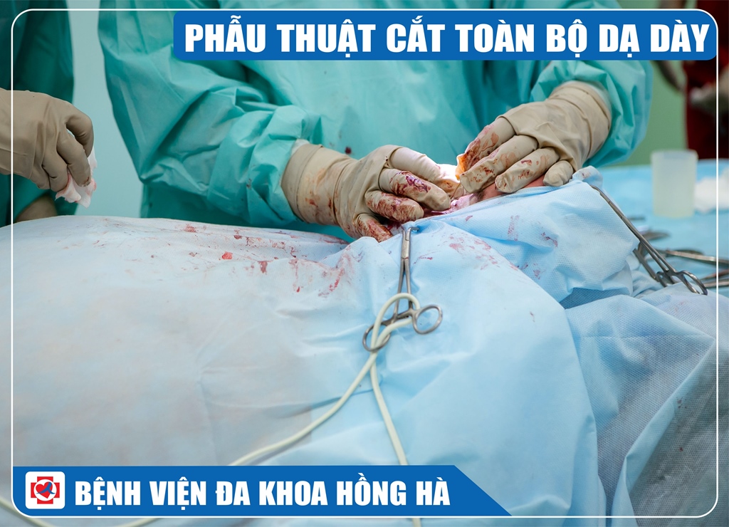 Hình Minh Hoạ Phẫu Thuật Cắt Toàn Bộ Dạ Dày