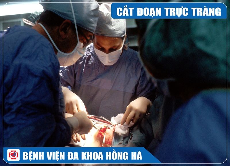 Hình Minh Hoạ Phẫu Thuật Nội Soi Cắt Đoạn Trực Tràng