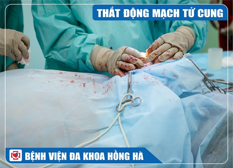 Hình Minh Hoạ Phẫu Thuật Thắt Động Mạch Tử Cung