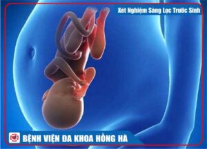 Xét Nghiệm Sàng Lọc Trước Sinh Double Test