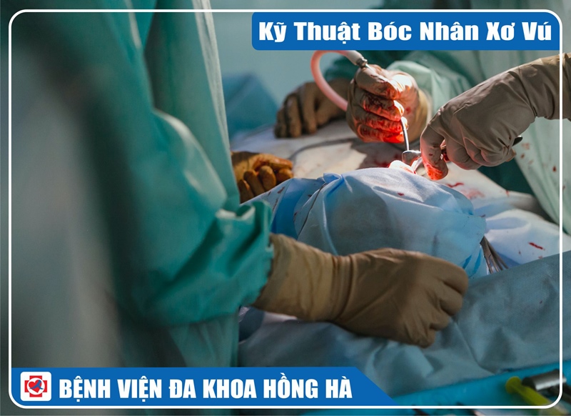 Hình Minh Hoạ Kỹ Thuật Bóc Nhân Xơ Vú