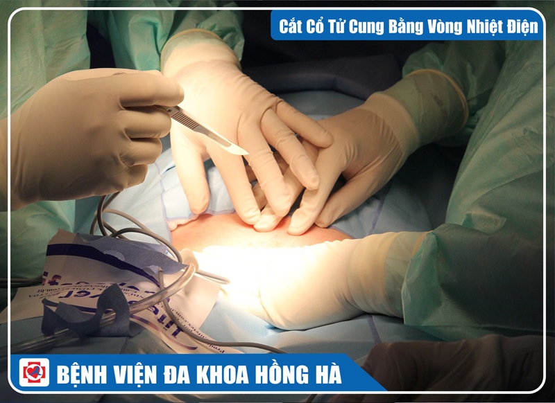 Hình minh hoạ Cắt Cổ Tử Cung Bằng Vòng Nhiệt Điện (Leep)