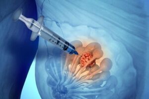 KĨ THUẬT FNA TRONG PHÁT HIỆN BỆNH LÝ TUYẾN VÚ