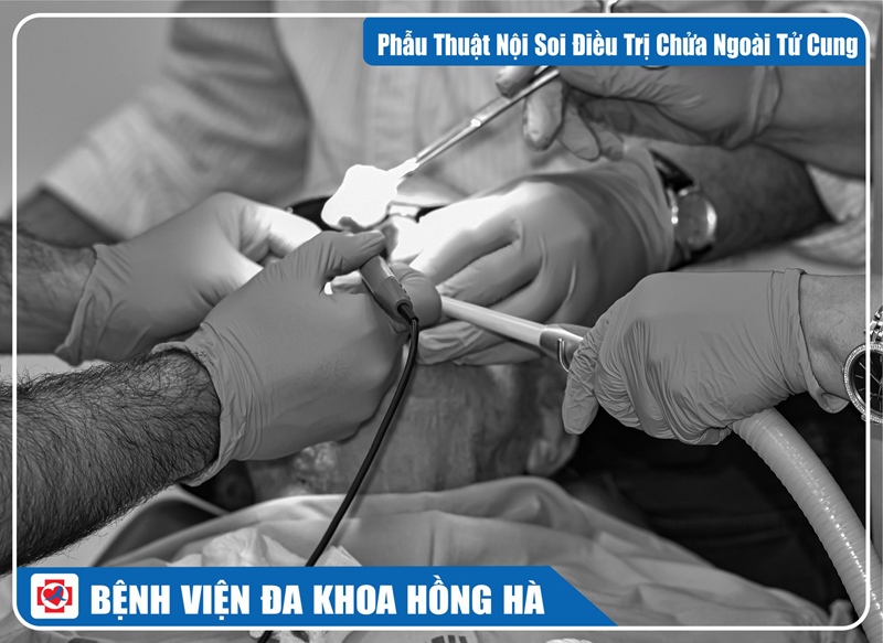 Hình Minh Hoạ Phẫu Thuật Nội Soi Điều Trị Chửa Ngoài Tử Cung