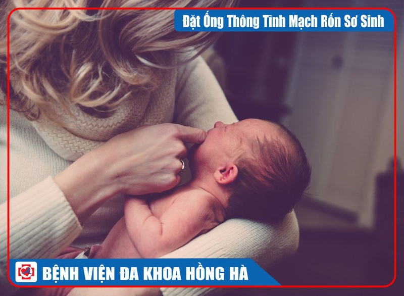 Hình Minh Hoạ Đặt Ống Thông Tĩnh Mạch Rốn Sơ Sinh