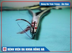 Đóng Rò Trực Tràng – Âm Đạo