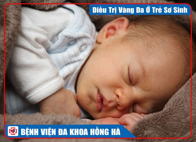 Anh Minh Hoạ Điều Trị Vàng Da Ở Trẻ Sơ Sinh Bằng Phương Pháp Chiếu Đèn
