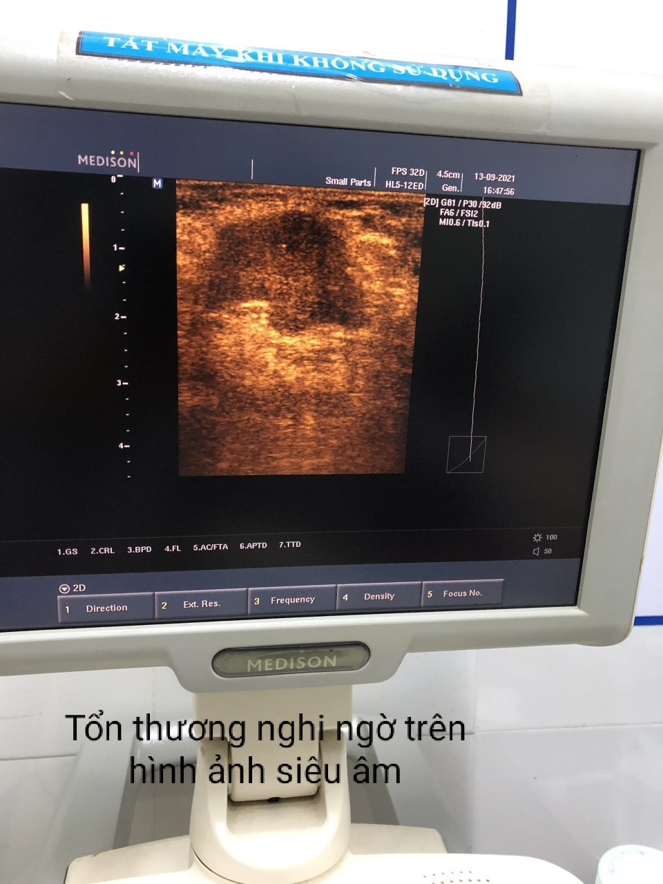 Tổn thương nghi ngờ trên hình ảnh siêu âm