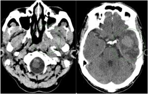 Phát hiện u vòm họng di căn não
