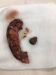 Phẫu Thuật Nội Soi Cắt Ruột Thừa Viêm Tại Hồng Lĩnh