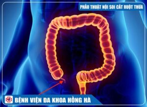 Phẫu Thuật Nội Soi Cắt Ruột Thừa Viêm Tại Bệnh Viện Đa Khoa Hồng Hà