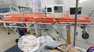 Cấp cứu ngừng tuần hoàn do đột quỵ