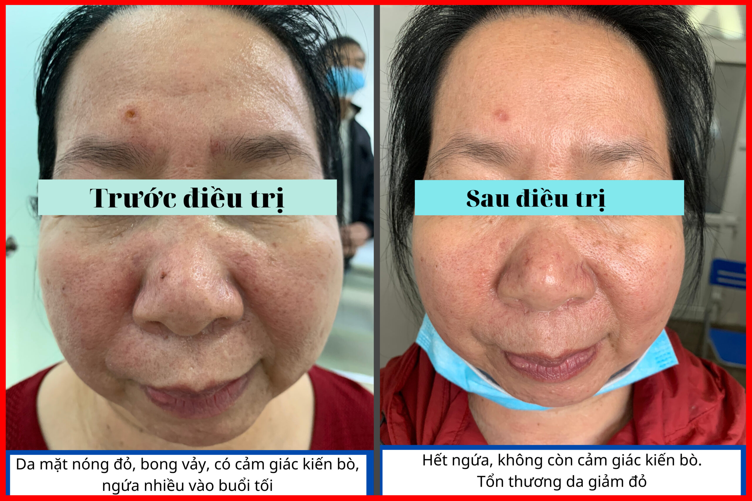 Hình ảnh bệnh nhân Chữa Viêm da do kí sinh trùng Demodex