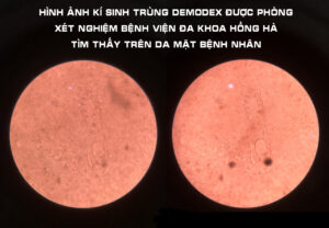 Chữa Viêm da do kí sinh trùng Demodex ở Hà Tĩnh