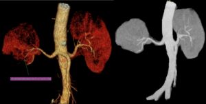 Hình Minh Hoạ Nhồi Máu Thận Cấp Bn N.N.H (Bn Được Dấu Tên )