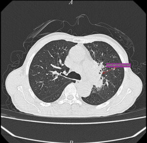 Hình 2: Mũi tên đánh dấu vị trí khối u, nốt, hạch