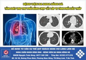 Tầm soát ung thư phổi bằng chụp Cắt Lớp Vi Tính phổi liều thấp