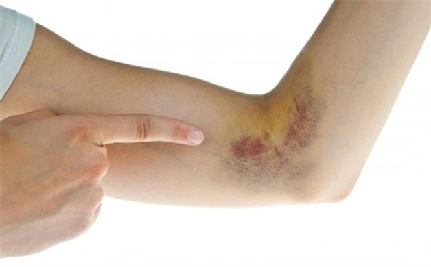 Bị bầm tím không rõ nguyên nhân