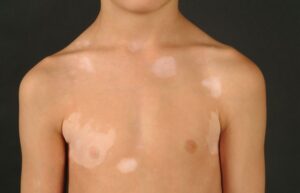 Hình minh hoạ Xét Nghiệm Vi Nấm Soi Tươi