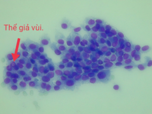 Hình ảnh thể giả vùi trong nhân, một trong những tiêu chuẩn chẩn đoán  ung thư  tuyến giáp típ nhú