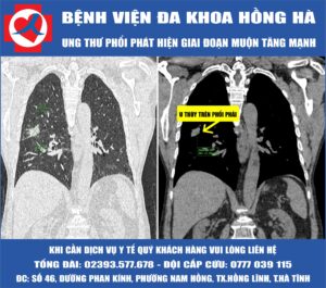 Bệnh Nhân Ung Thư Phổi Phát Hiện Giai Đoạn Muộn Tăng Mạnh