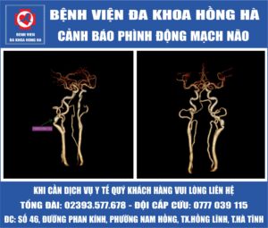Ảnh minh họa bài viết Cảnh báo phình động mạch não tăng cao