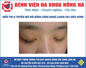 Hình Minh Họa Điều trị u ống tuyến mồ hôi lành tính tại Hồng Lĩnh Hà Tĩnh