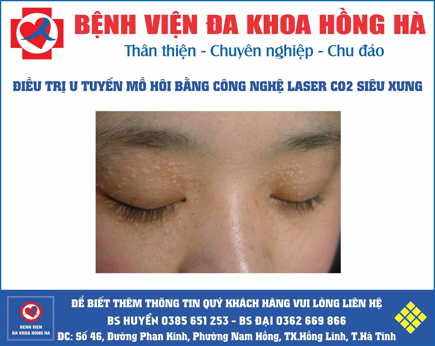 Hình Minh Họa Điều trị u ống tuyến mồ hôi lành tính tại Hồng Lĩnh Hà Tĩnh