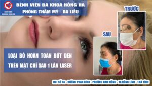 Hình minh họa Loại Bỏ Hoàn Toàn Bớt Đen Trên Mặt