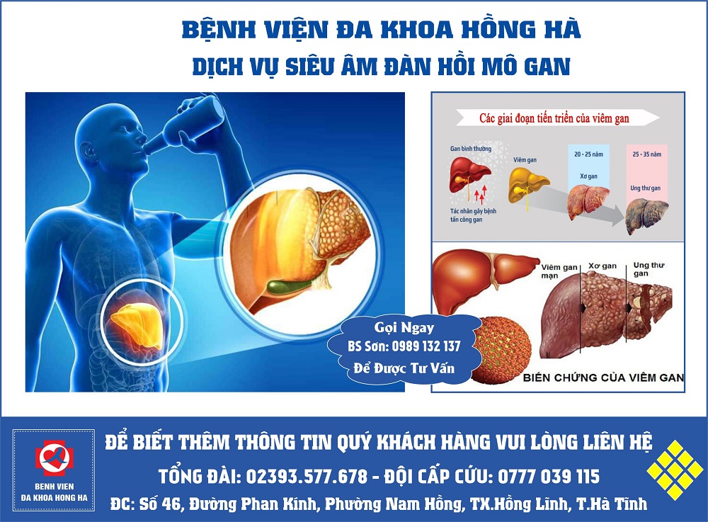 Hình minh hoạ Siêu âm đàn hồi mô gan hồng lĩnh
