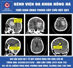 Hình minh họa thời gian vàng trong cấp cứu đột quỵ