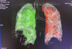 Di chứng phổi hậu covid 19 - Bệnh viện đa khoa Hồng Hà