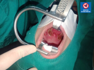 Bệnh nhân sau khi cắt AMYDAL bằng dao PLASMA