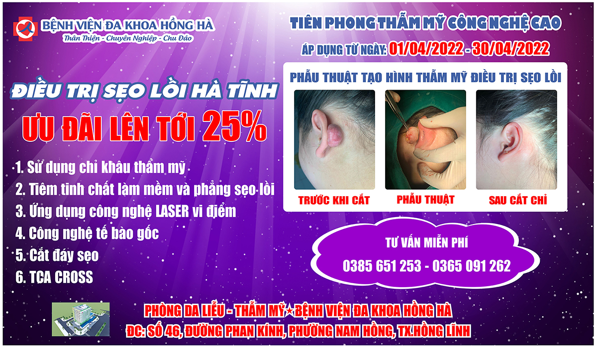 Điều trị sẹo lồi tại Hà Tĩnh