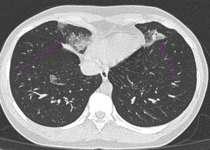 Hình Ảnh Chụp CT chuẩn đoán tổn thương phổi do Covid 19