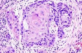 Hình ảnh ung thư dạ dày dưới kính hiển vi sau khi mẫu sinh thiết được xử lý