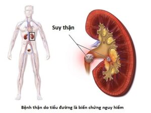 Hình minh họa Xét Nghiệm Chức Năng Thận