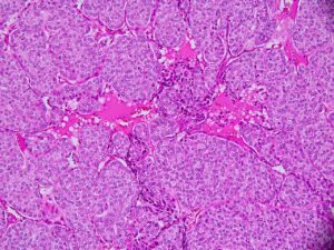 Hình ảnh ung thư giáp típ nang trên tiêu bản mô bệnh học