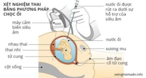 Hình minh hoạ Các Phương Pháp Sàng Lọc Trước Sinh Hiện Nay Phần 2