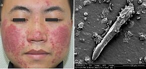 Hình minh hoạ Xét Nghiệm Soi Tươi Tìm Ký Sinh Trùng Demodex