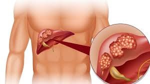 Hình minh hoạ Xét Nghiệm Test Nhanh Viên Gan A